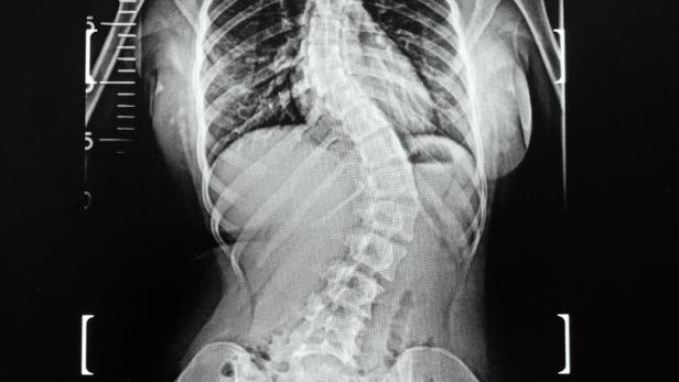 An,X-ray,Of,Whole,Spine,Showing,Spine,Of,All,Parts