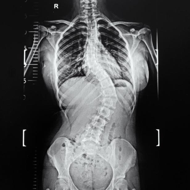 An,X-ray,Of,Whole,Spine,Showing,Spine,Of,All,Parts